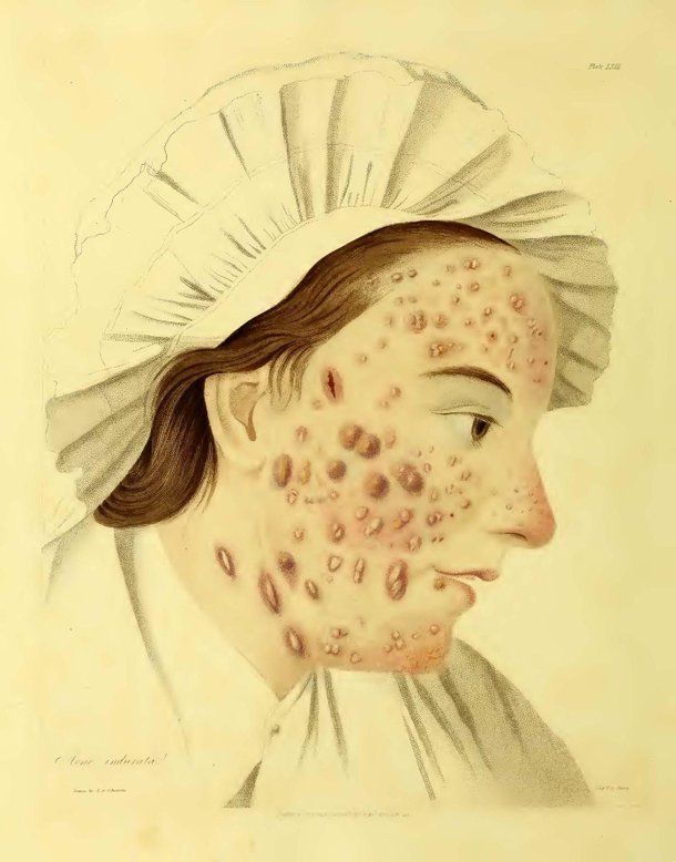 De urina a mercúrio: como a acne era tratada na Antiguidade