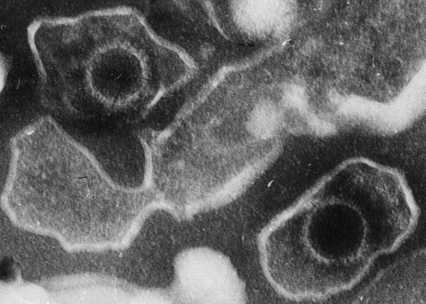 Cientistas debatem papel de vírus em casos de esclerose múltipla